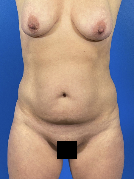 Tummy Tuck Before and After | Plastic Surgery Associates of Valdosta