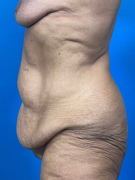 Tummy Tuck Before and After | Plastic Surgery Associates of Valdosta