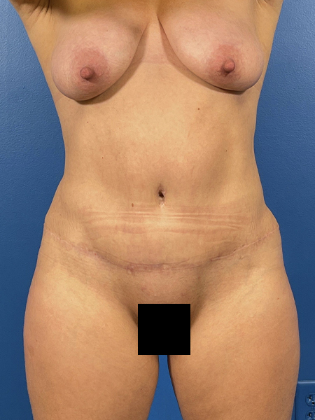 Tummy Tuck Before and After | Plastic Surgery Associates of Valdosta