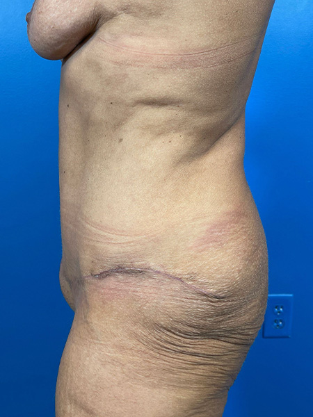 Tummy Tuck Before and After | Plastic Surgery Associates of Valdosta