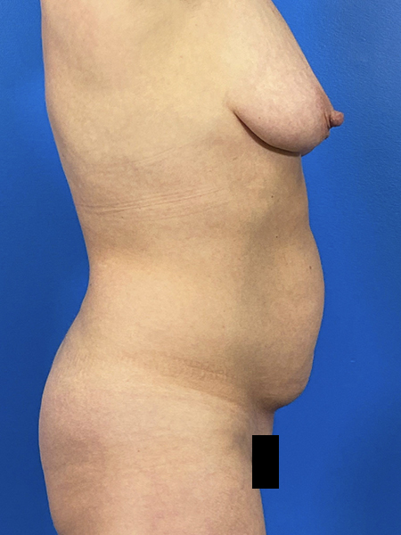 Tummy Tuck Before and After | Plastic Surgery Associates of Valdosta