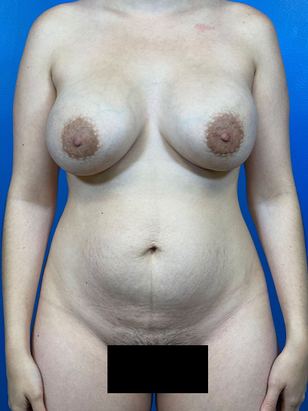 Tummy Tuck Before and After | Plastic Surgery Associates of Valdosta