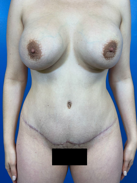 Tummy Tuck Before and After | Plastic Surgery Associates of Valdosta