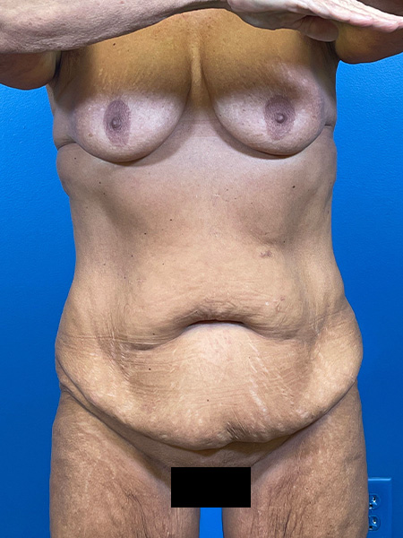 Tummy Tuck Before and After | Plastic Surgery Associates of Valdosta