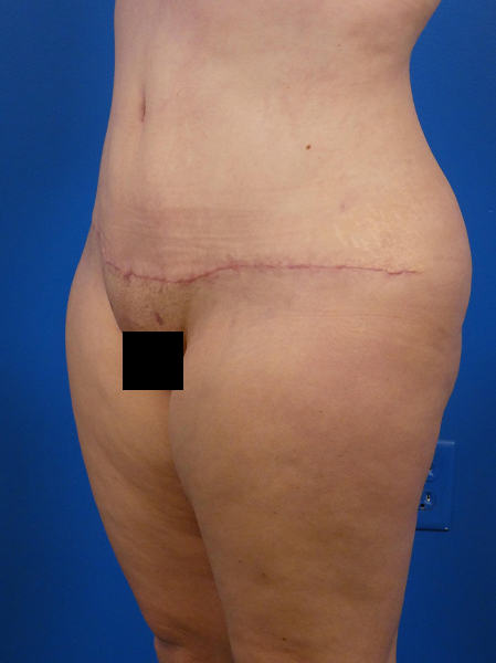 Tummy Tuck Before and After | Plastic Surgery Associates of Valdosta