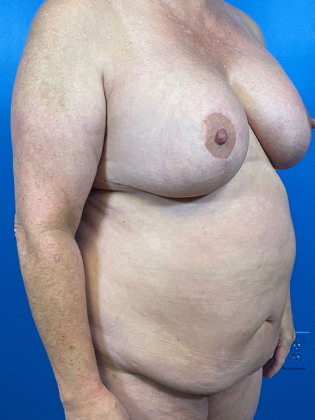 Tummy Tuck Before and After | Plastic Surgery Associates of Valdosta