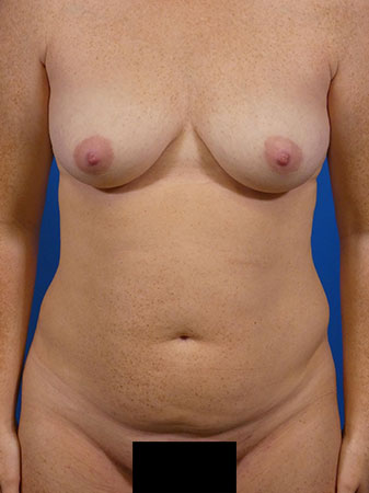 Tummy Tuck Before and After | Plastic Surgery Associates of Valdosta