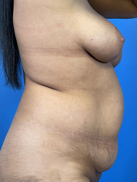 Tummy Tuck Before and After | Plastic Surgery Associates of Valdosta