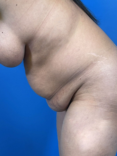 Tummy Tuck Before and After | Plastic Surgery Associates of Valdosta