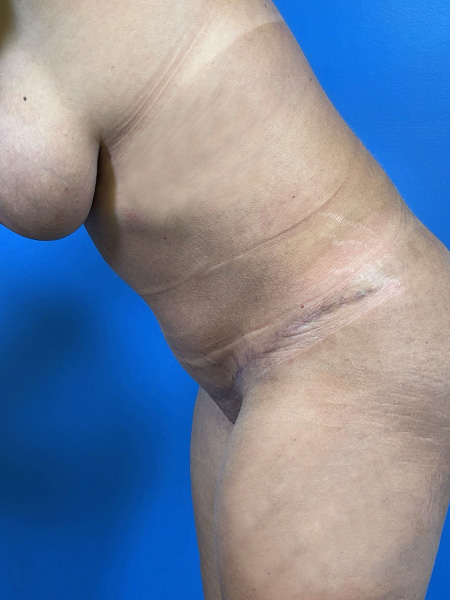 Tummy Tuck Before and After | Plastic Surgery Associates of Valdosta