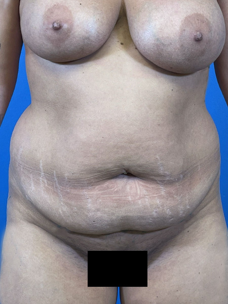 Tummy Tuck Before and After | Plastic Surgery Associates of Valdosta