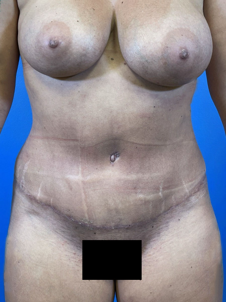 Tummy Tuck Before and After | Plastic Surgery Associates of Valdosta