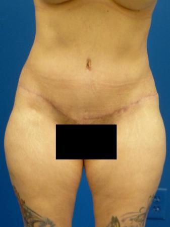 Tummy Tuck Before and After | Plastic Surgery Associates of Valdosta