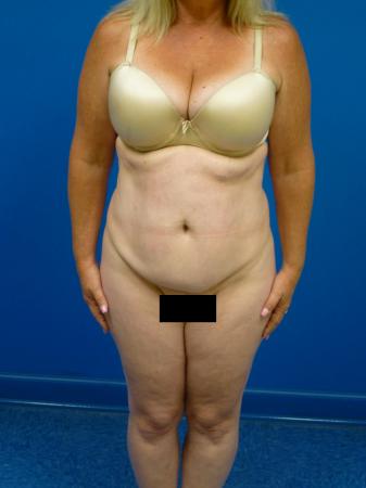Tummy Tuck Before and After | Plastic Surgery Associates of Valdosta