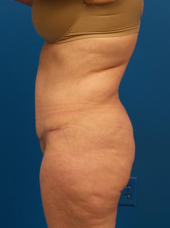 Tummy Tuck Before and After | Plastic Surgery Associates of Valdosta