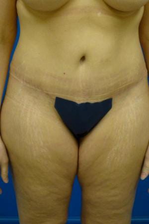 Tummy Tuck Before and After | Plastic Surgery Associates of Valdosta