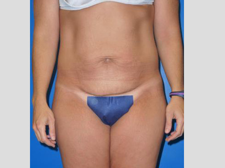 Tummy Tuck Before and After | Plastic Surgery Associates of Valdosta