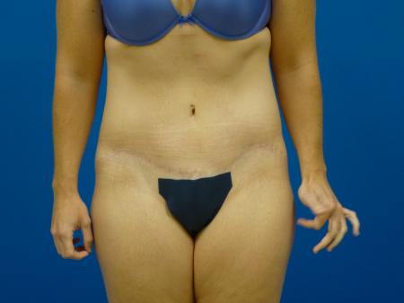 Tummy Tuck Before and After | Plastic Surgery Associates of Valdosta