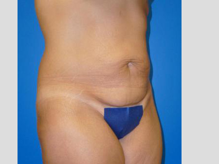 Tummy Tuck Before and After | Plastic Surgery Associates of Valdosta