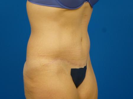 Tummy Tuck Before and After | Plastic Surgery Associates of Valdosta