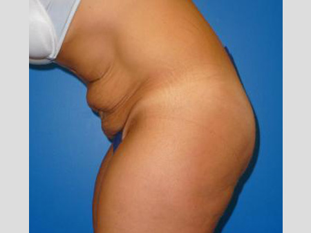 Tummy Tuck Before and After | Plastic Surgery Associates of Valdosta