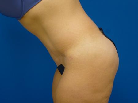 Tummy Tuck Before and After | Plastic Surgery Associates of Valdosta