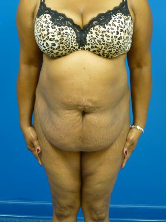 Tummy Tuck Before and After | Plastic Surgery Associates of Valdosta