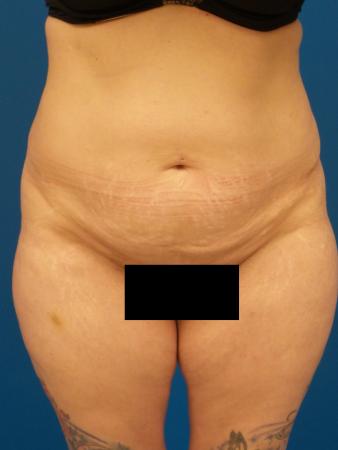 Tummy Tuck Before and After | Plastic Surgery Associates of Valdosta