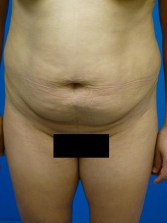 Tummy Tuck Before and After | Plastic Surgery Associates of Valdosta