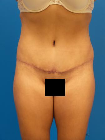 Tummy Tuck Before and After | Plastic Surgery Associates of Valdosta