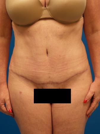 Tummy Tuck Before and After | Plastic Surgery Associates of Valdosta