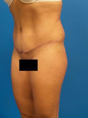 Tummy Tuck Before and After | Plastic Surgery Associates of Valdosta