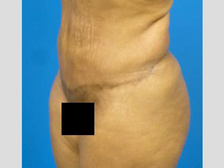 Tummy Tuck Before and After | Plastic Surgery Associates of Valdosta