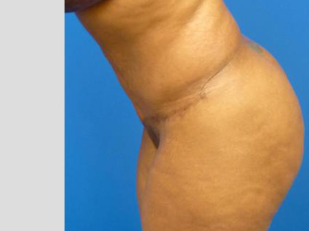 Tummy Tuck Before and After | Plastic Surgery Associates of Valdosta