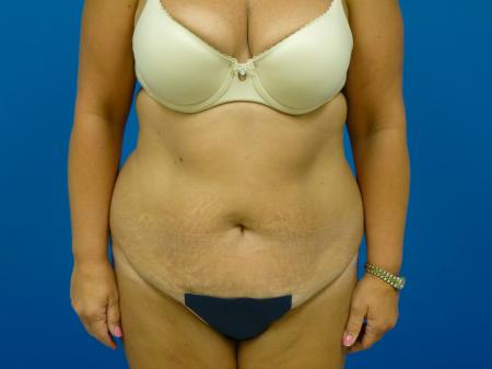 Tummy Tuck Before and After | Plastic Surgery Associates of Valdosta