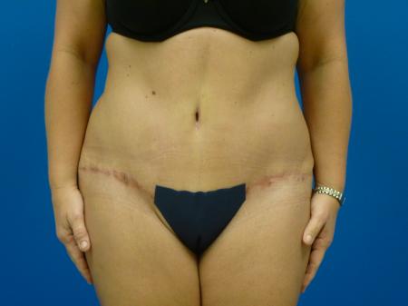 Tummy Tuck Before and After | Plastic Surgery Associates of Valdosta