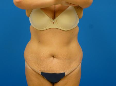 Tummy Tuck Before and After | Plastic Surgery Associates of Valdosta