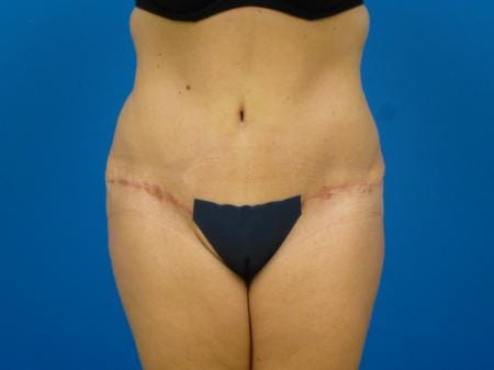 Tummy Tuck Before and After | Plastic Surgery Associates of Valdosta