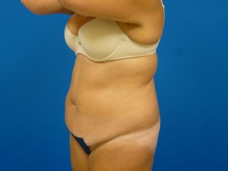 Tummy Tuck Before and After | Plastic Surgery Associates of Valdosta