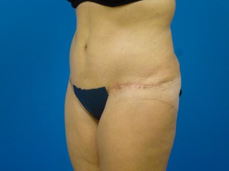 Tummy Tuck Before and After | Plastic Surgery Associates of Valdosta