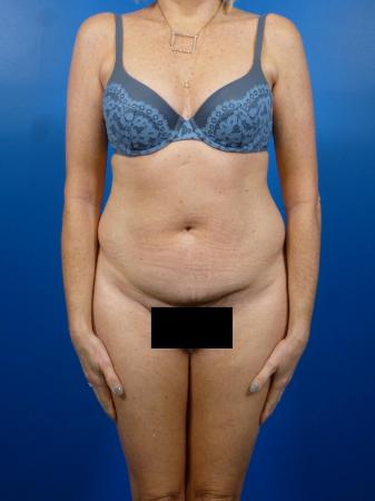 Tummy Tuck Before and After | Plastic Surgery Associates of Valdosta