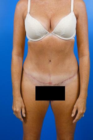 Tummy Tuck Before and After | Plastic Surgery Associates of Valdosta