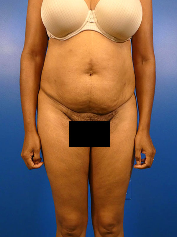 Tummy Tuck Before and After | Plastic Surgery Associates of Valdosta