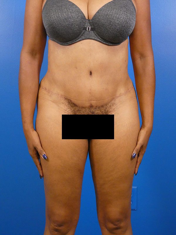 Tummy Tuck Before and After | Plastic Surgery Associates of Valdosta