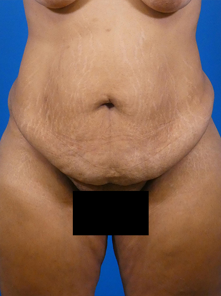 Tummy Tuck Before and After | Plastic Surgery Associates of Valdosta