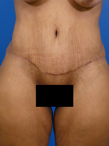 Tummy Tuck Before and After | Plastic Surgery Associates of Valdosta