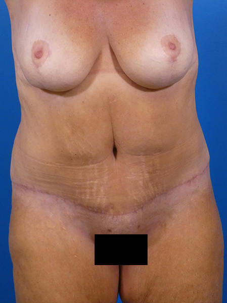 Tummy Tuck Before and After | Plastic Surgery Associates of Valdosta