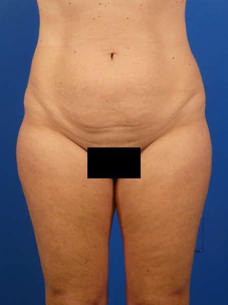 Tummy Tuck Before and After | Plastic Surgery Associates of Valdosta