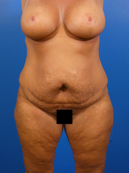 Tummy Tuck Before and After | Plastic Surgery Associates of Valdosta