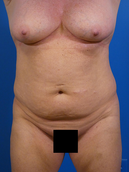 Tummy Tuck Before and After | Plastic Surgery Associates of Valdosta